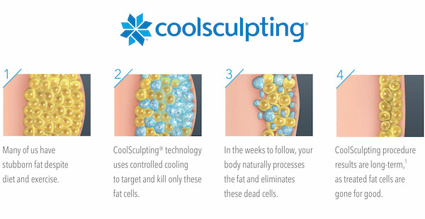 Non-Invasive Fat Removal: An Honest Review on CoolSculpting